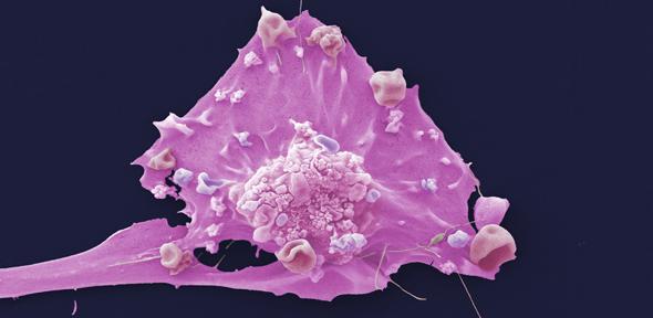 Breast cancer cells