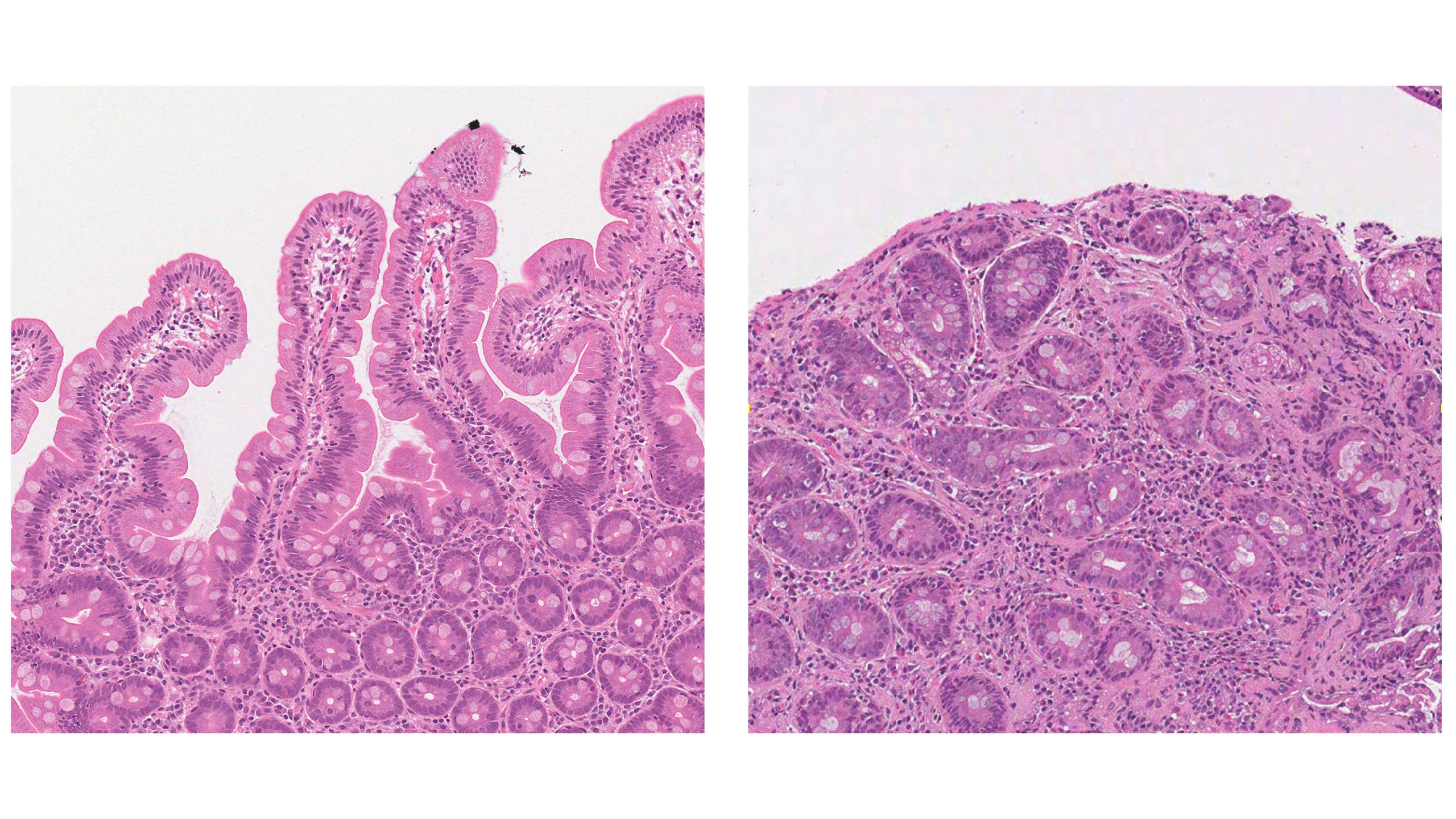 AIがセリアック病診断において病理医と同等の精度を発揮(AI is as good as pathologists at diagnosing coeliac disease, study finds)