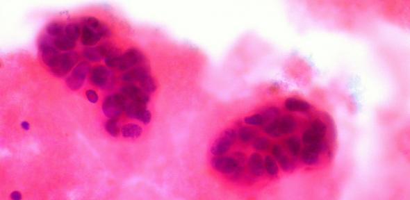 Metastatic Breast Cancer in Pleural Fluid