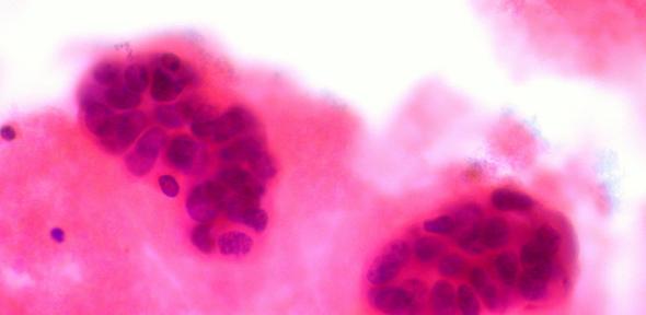 Metastatic Breast Cancer in Pleural Fluid
