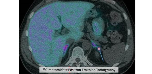 11C metomidate PET CT of small Conn's tumour