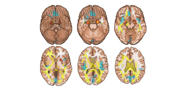 Brain scans from study
