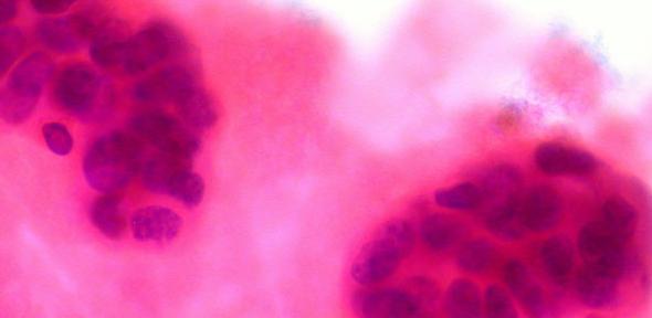 metastatic breast cancer in pleural fluid