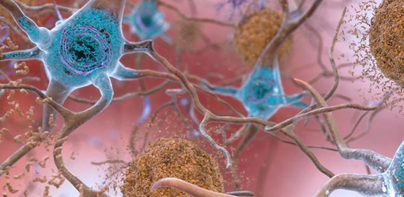 Beta-Amyloid Plaques and Tau in the Brain