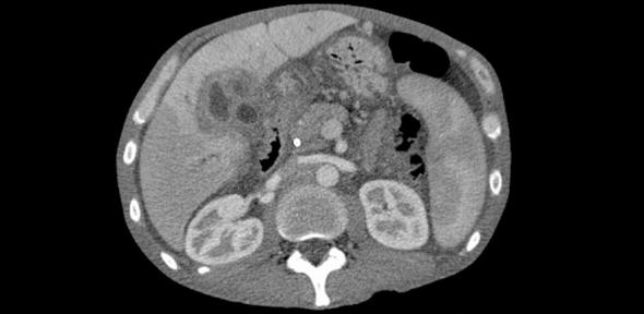 CT scan showing cholangiocarcinoma