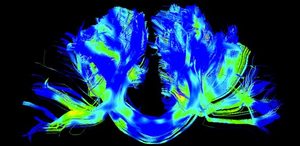 Corpus callosum, left-right connections, in a Parkinson's brain