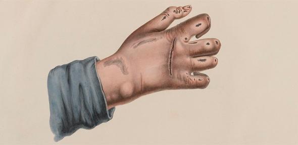 Hand showing leprosy