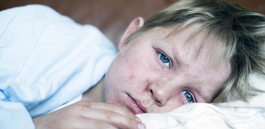 Very sick 5 year old little boy fighting measles infection, boy is laying in bed under the blanket with an agonizing expression, boy is covered with rash caused by virus.