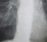 A chest X-ray demonstrating severe COPD (cropped)