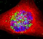 A cancer cell containing the nanoparticles. The nanoparticles are coloured green, and have entered the nucleus, which is the area in blue