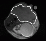 An abdominal tumour (outlined in white) 'feeding on' carbon-13-labelled glucose (orange) provides a means of testing when cancer drugs are effective enough to affect the health of the tumour
