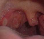 Throat ulcer