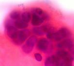 metastatic breast cancer in pleural fluid