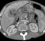 CT scan showing cholangiocarcinoma