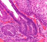 Image of an oesophageal carcinoma 
