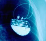 X-Ray Showing Pacemaker