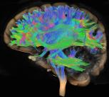 Diffusion tensor imaging (DTI) MRI of the human brain - stock photo