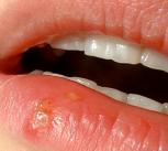 cold sore