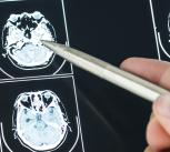 Closeup of brain MRI scan result