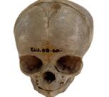 Dissected foetal skull dating from the 1800s, originally held in the University of Cambridge Anatomy Museum