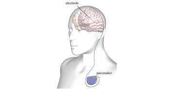 Graphic demonstrating deep brain stimulation
