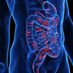 Artist's impression of Crohn's disease