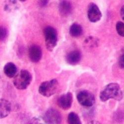 Micrograph of a plasmacytoma, a hematological malignancy