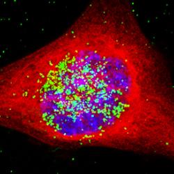 A cancer cell containing the nanoparticles. The nanoparticles are coloured green, and have entered the nucleus, which is the area in blue