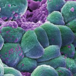 A cluster of breast cancer cells.