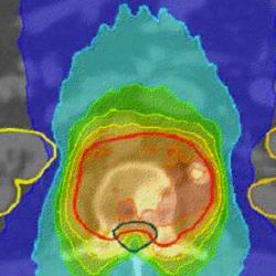 Image-guided intensity modulated RT plan for a patient with a spinal  tumour. The radiation dose is shaped away from the kidneys (yellow  outlines) and the spinal nerve roots (inside the green outline). The colour wash represents radiation dose