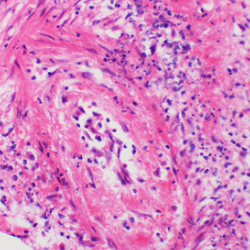 Pulmonary hypertension-associated vasculitis
