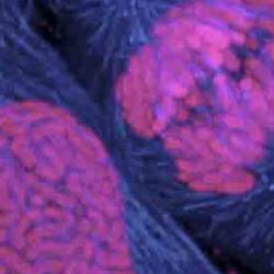 Breast cancer cells