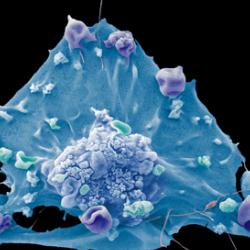 Breast cancer cell