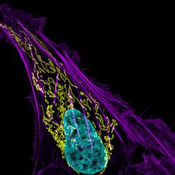 Bone cancer cell (nucleus in light blue)