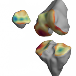 3D model of a knee with osteoarthritis