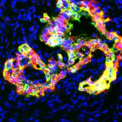 Pre-cancerous pancreatic tissue in mice