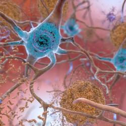 Beta-Amyloid Plaques and Tau in the Brain
