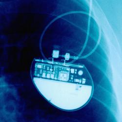 X-Ray Showing Pacemaker