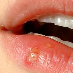 cold sore