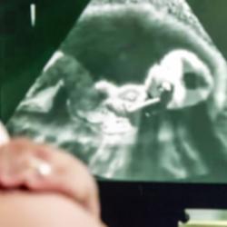 Pregnancy scan