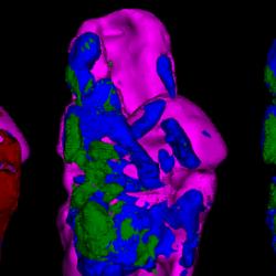 Imaging atherosclerotic calcification or ‘hardening of the arteries’ using positron emission tomography