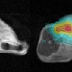 Lymphoma