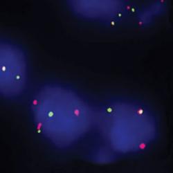 Lymphoma