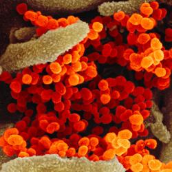 Scanning electron microscope image of SARS-CoV-2 (orange) emerging from the surface of cells (green) cultured in the lab.