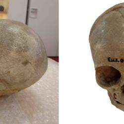 Dissected foetal skull dating from the 1800s, originally held in the University of Cambridge Anatomy Museum