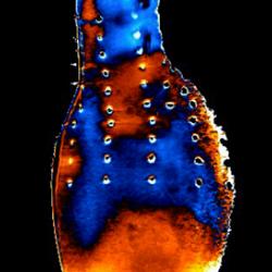 Abdominal aortic aneurysm