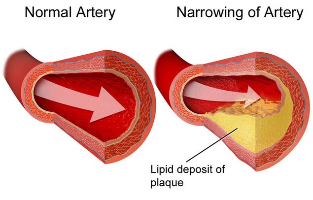 Illustration showing build up of lipids (fat) in the artery