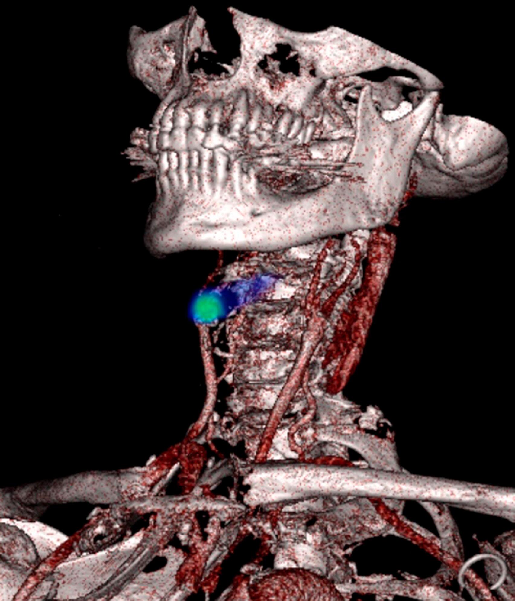 Image highlighting carotid artery
