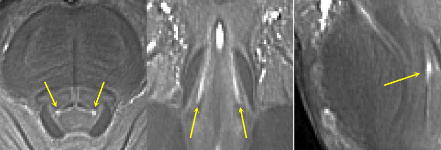 Locus coeruleus as seen in 7T MRI scan