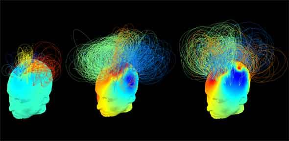 Electrical brain 'signatures'. The patient to the left is in a vegetative state; the patient in the middle is also in a vegetative state but their brain appears as conscious as the brain of the healthy individual at the right.